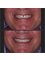 Dr. Moustafa Nashat - Esthetic composite fillings to close gap between teeth  