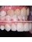 Dr. Moustafa Nashat - E-Max Veneers to enhance smile and color 