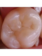 Dental Composite - Medspa