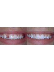 Dental Bridges - Dental Cosmetic Clinic(Dr/ Hesham Rashed)