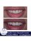 Smile Care Dental Clinic - Tooth fracture correction 
