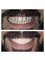 Smile Care Dental Clinic - smile make over using Zirconium Resorations 