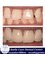 Smile Care Dental Clinic - Treatment of Teeth Spacing 