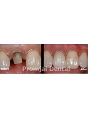 Dental Crowns - Highdent Center