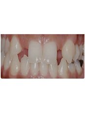 Dental Implants - Lorenzana Dental Center