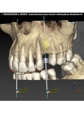 Dental Implants - Bensoussan & Lucien dentists Antibes
