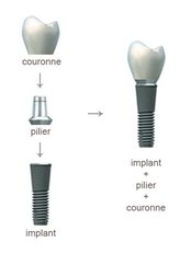 Dental Implants - Dental Implants Paris