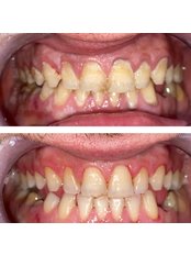 Teeth Cleaning - Dental Clinic Zeppelin