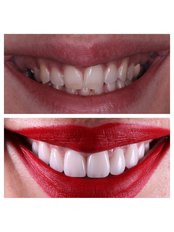 EMAX Veneers - Dental Clinic Zeppelin
