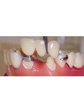 Dental Crowns - Elite