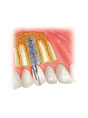 Dental Implants - Elite