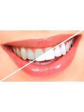 Teeth Whitening - Elite