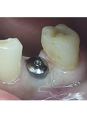 Dental Implants - HABA Clinics
