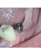 Dental Implants - HABA Clinics