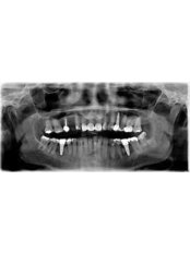 Dental Implants - Healthy Dent