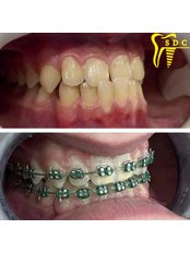 Braces - SDC - Spanderashvili Dental Clinic