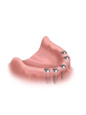 All-on-6 Dental Implants - DentalFirst - Dental Practice of Excellence in Berlin