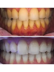 Teeth Whitening - Aurum Wellness