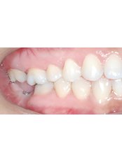 Adult Braces - Center Of Dental Expertise in Melissia