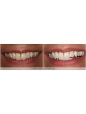 Teeth Whitening - Dent Artistry Contemporary Prosthodontics