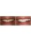 Dent Artistry Contemporary Prosthodontics - ZOOM whitening 