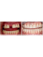Dental Implants - Dent Artistry Contemporary Prosthodontics