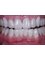 Dental Aesthetics Athens - Full mouth reconstruction with combined veneers  in the upper and crowns in the lower. 