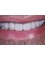 Dental Aesthetics Athens - Full mouth rehabilitation with ceramic veneers 