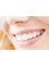 Dental Aesthetics Athens - Pleasant smile - Success criteria met- lateral aspect 