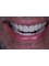 Dental Aesthetics Athens - Full mouth rehabilitation with ceramic veneers and crowns 