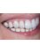 Dental Aesthetics Athens - Smile makeover with ultra aesthetic composite veneers. Composites can be premium . 