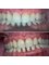Dr. Teodora Dumitriu - Teeth cleaning- scaling, Airflow Profijet 