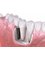 Odontogenesis - Dental Implants Illustration  