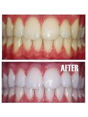 BriteSmile™ Teeth Whitening - Skourasdent Clinic