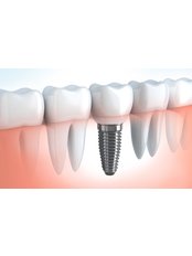 Dental Implants - Skourasdent Clinic
