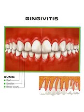 Gingivitis Treatment - Skourasdent Clinic