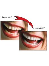 Chemical Teeth Whitening - Skourasdent Clinic