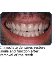 Immediate Dentures - Skourasdent Clinic