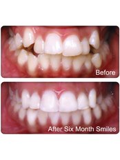 Six Month Smiles™ - Skourasdent Clinic