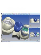 CAD/CAM Dental Restorations - Skourasdent Clinic