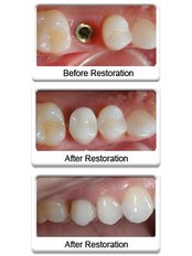Restoration of Implants - Skourasdent Clinic