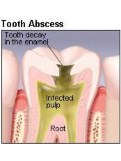 Treatment of Dental Abscess - Skourasdent Clinic