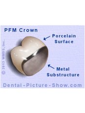 PFM Crown - Skourasdent Clinic