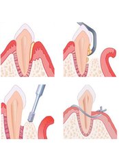 Gum Surgery - Skourasdent Clinic