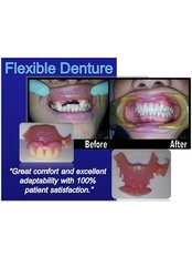 Flexible Partial Dentures - Skourasdent Clinic