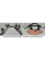Chrome Dentures - Skourasdent Clinic