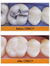 CEREC Dental Restorations - Skourasdent Clinic