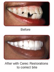 CEREC Dental Restorations - Skourasdent Clinic