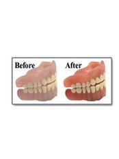 Dentures Repair - Skourasdent Clinic