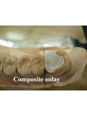 Composite Resin Inlay or Onlay - Skourasdent Clinic